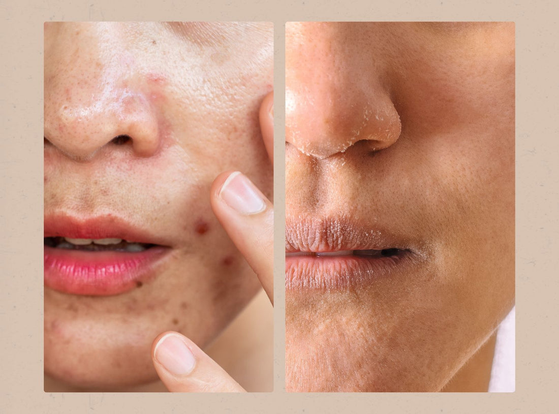 Do you actually have Oily Skin? Here's the Top 4 signs (with a surprising caveat!)