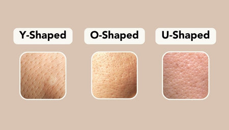 What is your Pore Shape saying about your skin?