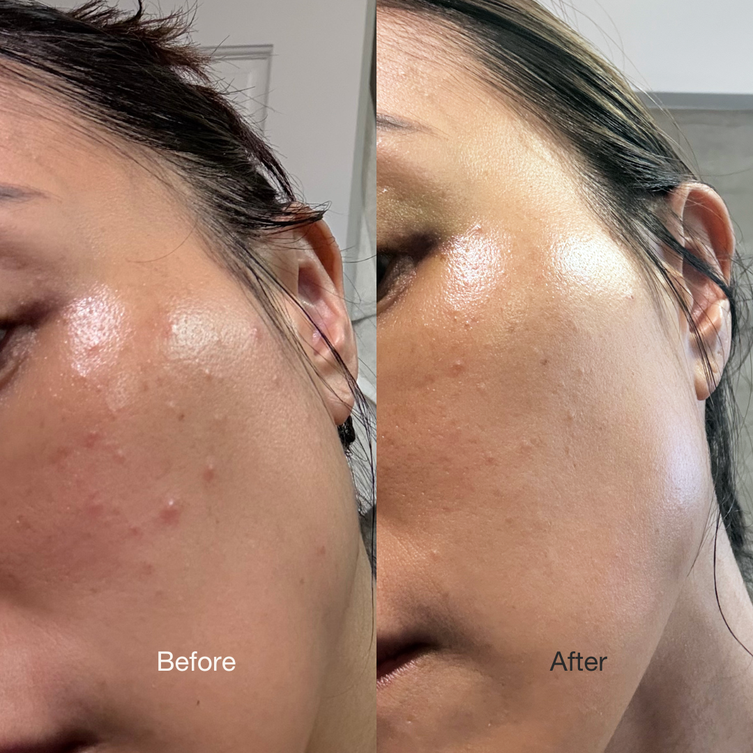 Before and after images showing skin texture over time, and pimples disappearing