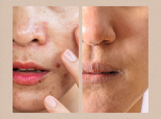 Do you actually have Oily Skin? Here's the Top 4 signs (with a surprising caveat!)