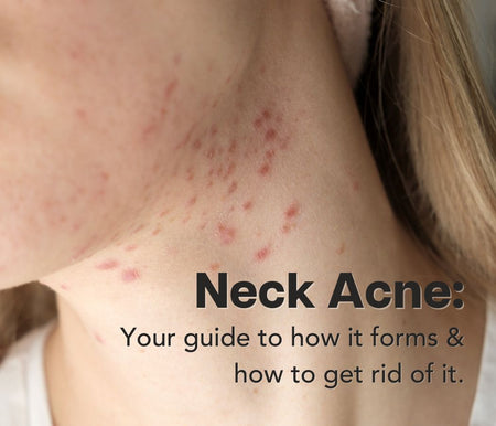 Neck Pimples! Unblocking those pesky, unwanted breakouts.