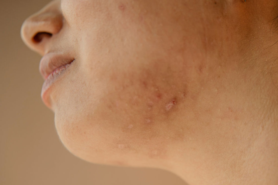 Neck Pimples! Unblocking those pesky, unwanted breakouts.