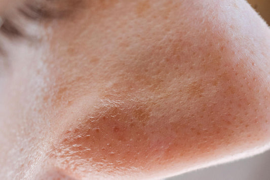 what causes enlarged pores and how to care for them