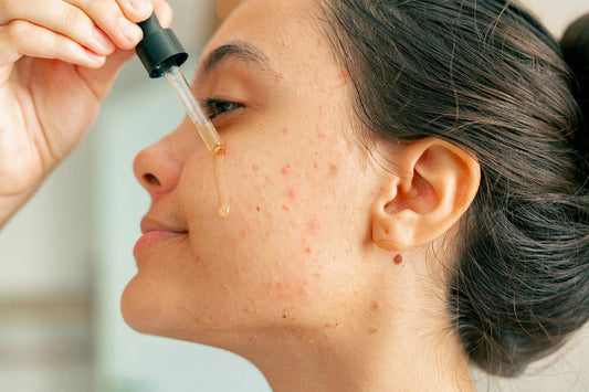 Can you treat pimples without using salicylic acid