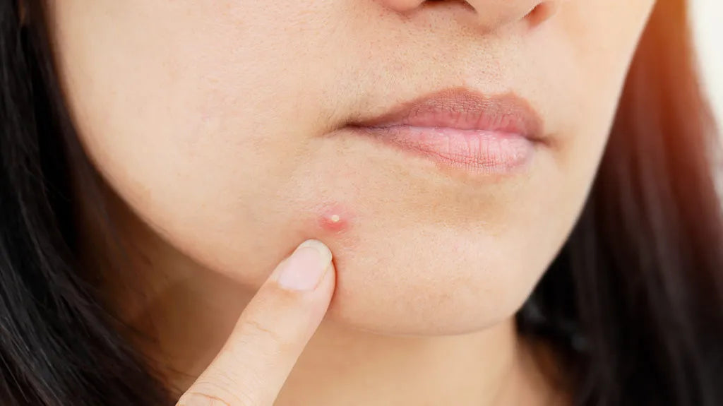 Should you pop a pimple or leave it alone