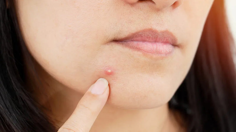 Pimples! To Pop or not to Pop?