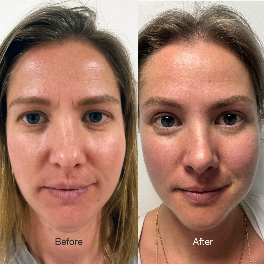 Side by side before and after photos of facial skin of Alya
