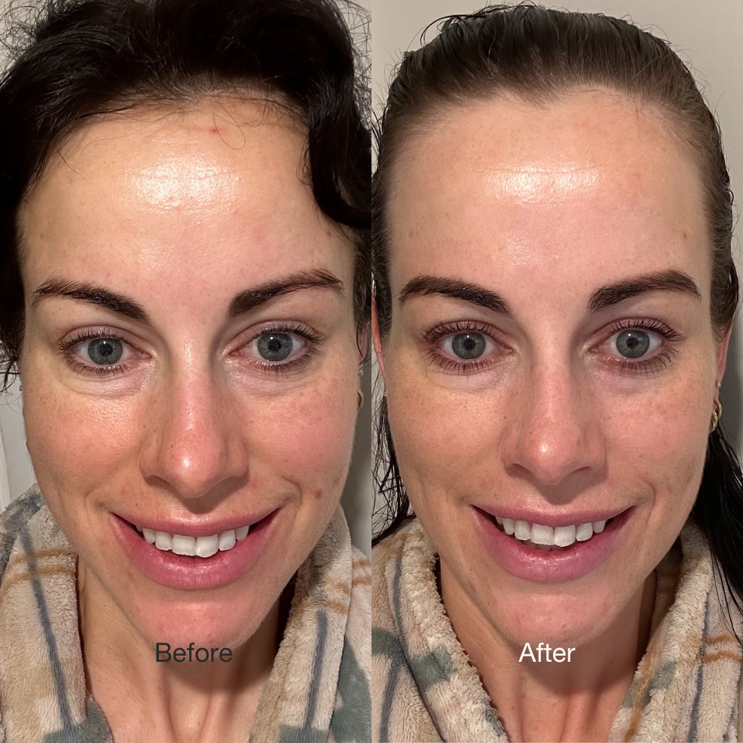 Images of before & after of Lily showing improvement on her skin
