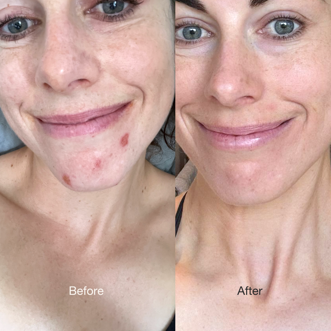 Before and after skincare routine showing changes in skin appearance of Lily 